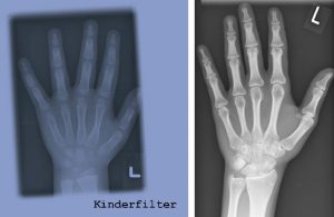 Spanien – Tests ergaben 70 Prozent der minderjährigen Zuwanderer sind Erwachsene